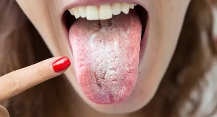 Oral Thrush